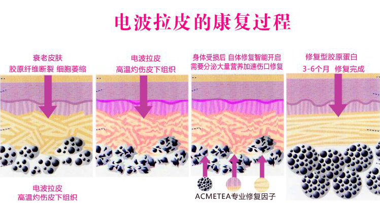 電波拉皮效果好嗎？術(shù)后會(huì)有副作用嗎？