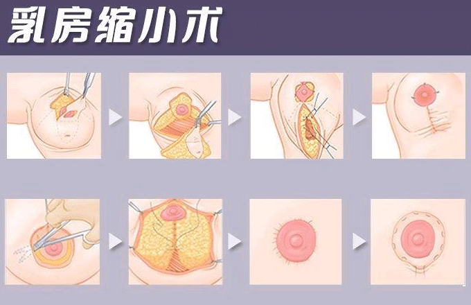 巨乳縮小手術(shù) 巨乳縮小手術(shù)