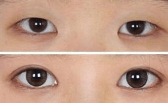 開眼角前后對比 開眼角前后對比