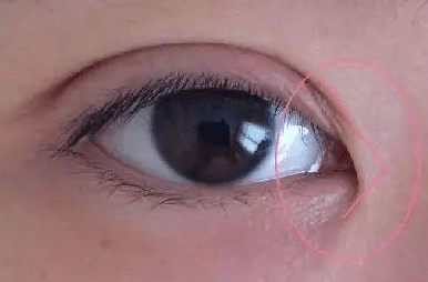 開(kāi)眼角恢復(fù) 開(kāi)眼角恢復(fù)