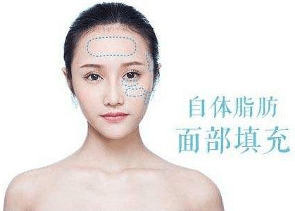 自體脂肪填充