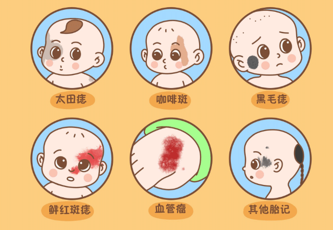 胎記分類 胎記分類
