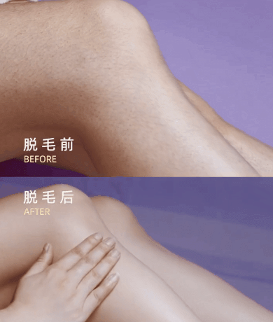 脫毛手術(shù)前后對比 脫毛手術(shù)前后對比