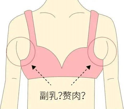 副乳 副乳