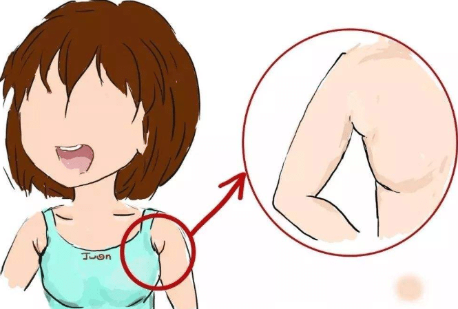 吸脂去副乳前后對比 吸脂去副乳前后對比
