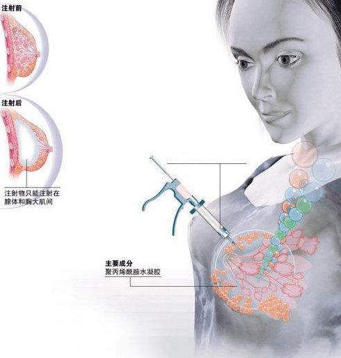 玻尿酸豐胸 玻尿酸豐胸