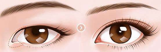 開眼角 開眼角