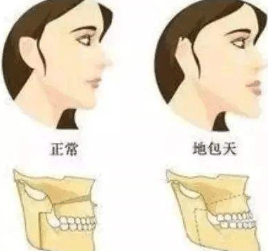 地包天 地包天