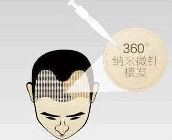 植發(fā)手術(shù) 植發(fā)手術(shù)