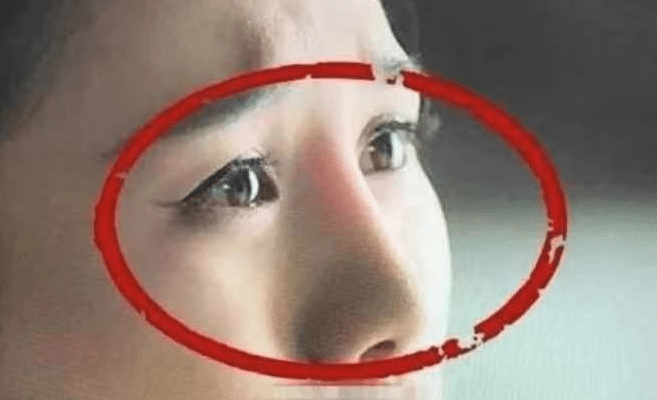 隆鼻假體透光 隆鼻假體透光