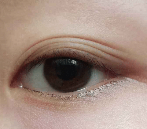 多眼皮 多眼皮
