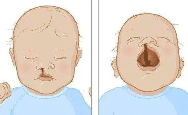 唇腭裂 唇腭裂