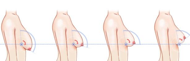 乳房上提手術(shù) 乳房上提手術(shù)