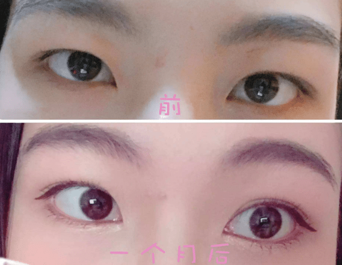 眼皮吸脂前后對比 眼皮吸脂前后對比