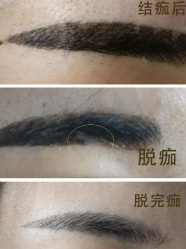 紋眉后結(jié)痂脫落 紋眉后結(jié)痂脫落