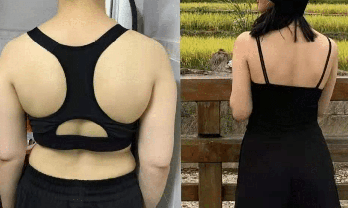 肩部吸脂前后對比 肩部吸脂前后對比