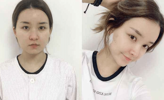 面部吸脂前后對比 面部吸脂前后對比