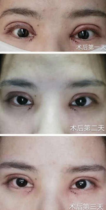 眼綜合術(shù)后護(hù)理 眼綜合術(shù)后護(hù)理