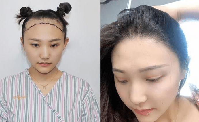 植發(fā)前后對比 植發(fā)前后對比