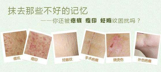 激光祛疤效果如何？術后有什么需要注意的？