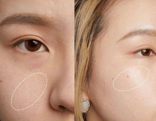 磨皮手術(shù)前后對比 磨皮手術(shù)前后對比