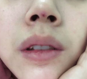 線雕鼻失敗 線雕鼻失敗