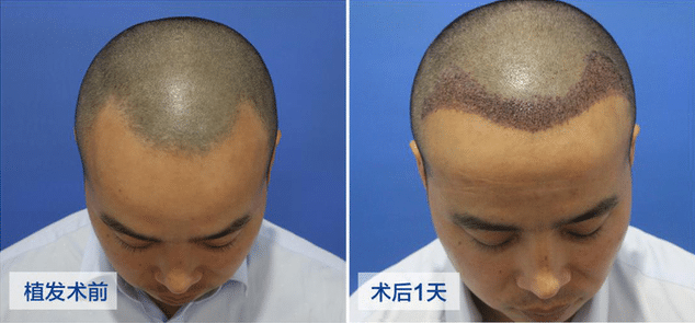 種植頭發(fā)要多少錢? 種植頭發(fā)要多少錢?