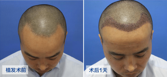 移植3000個毛囊要多少錢?植發(fā)后多久可以恢復? 移植3000個毛囊要多少錢?植發(fā)后多久可以恢復?