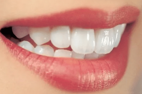 烤瓷牙 烤瓷牙