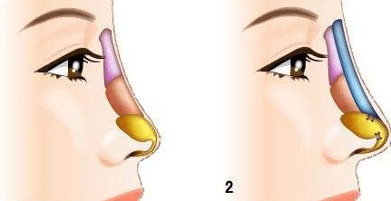 膨體隆鼻