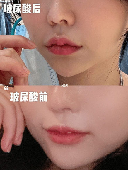 玻尿酸豐唇的效果怎么樣?