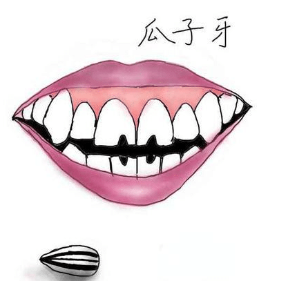瓜子牙 瓜子牙
