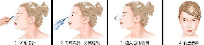 耳軟骨隆鼻 耳軟骨隆鼻