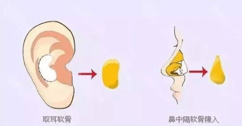 耳軟骨 耳軟骨