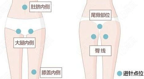 大腿吸脂過程 大腿吸脂過程