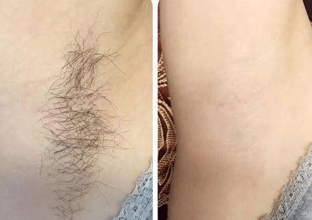 激光脫腋毛前后對比 激光脫腋毛前后對比