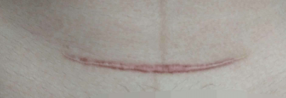剖腹產疤痕 剖腹產疤痕