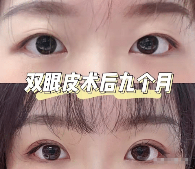 雙眼皮哪個(gè)好?哪種雙眼皮手術(shù)方法適合我? 雙眼皮哪個(gè)好?哪種雙眼皮手術(shù)方法適合我?
