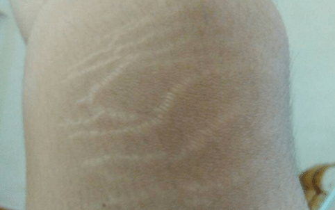 肥胖紋 肥胖紋