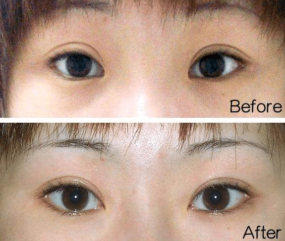 開眼角前后對比 開眼角前后對比