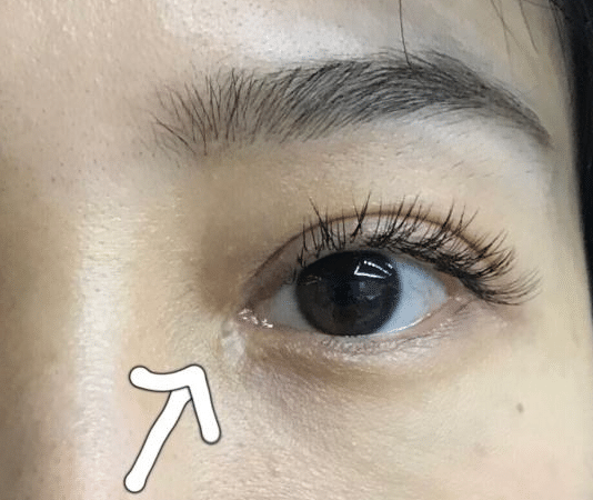 開眼角后的疤痕增生 開眼角后的疤痕增生