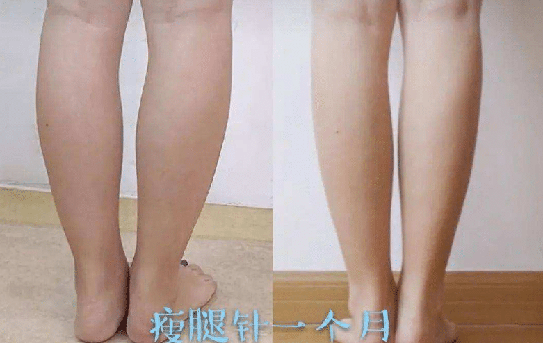 瘦腿針前后對(duì)比 瘦腿針前后對(duì)比