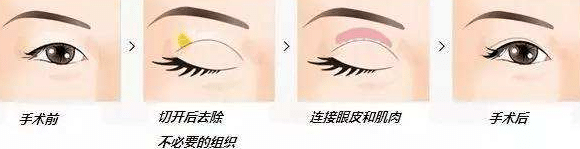 重瞼術(shù) 重瞼術(shù)