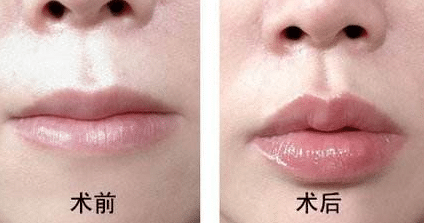 玻尿酸豐唇前后對比 玻尿酸豐唇前后對比