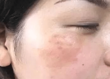 妊娠斑 妊娠斑