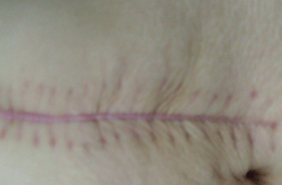 剖腹產(chǎn)瘢痕 剖腹產(chǎn)瘢痕