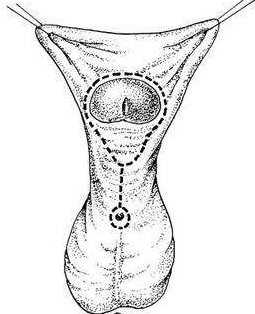 陰囊除皺術(shù) 陰囊除皺術(shù)