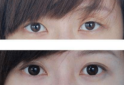 埋線雙眼皮前后對(duì)比 埋線雙眼皮前后對(duì)比
