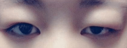 脂肪型腫泡眼