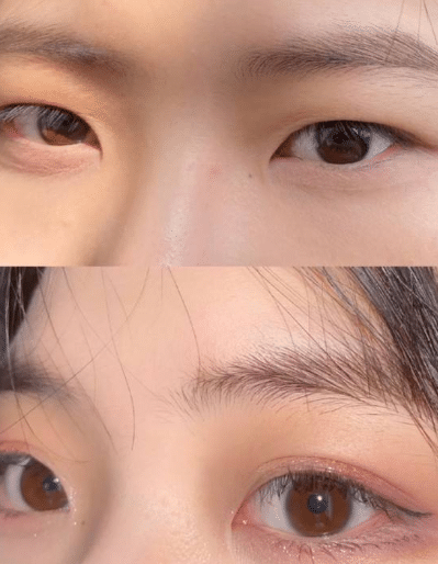 腫眼泡前后對比